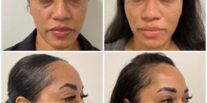 Facial Artistry at Eternia Medspa